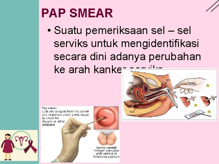 PAP SMEAR • Suatu pemeriksaan sel – sel serviks untuk mengidentifikasi secara dini adanya