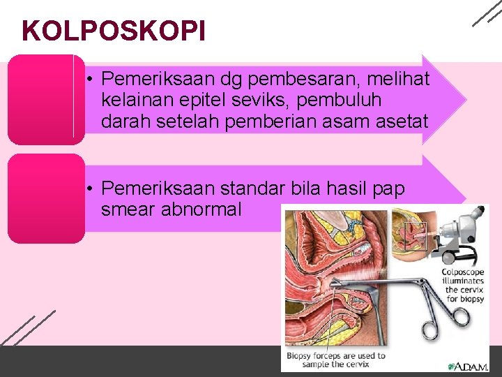 KOLPOSKOPI • Pemeriksaan dg pembesaran, melihat kelainan epitel seviks, pembuluh darah setelah pemberian asam