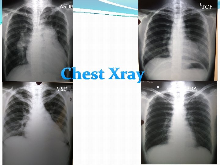 ASD TOF Chest Xray VSD PDA 