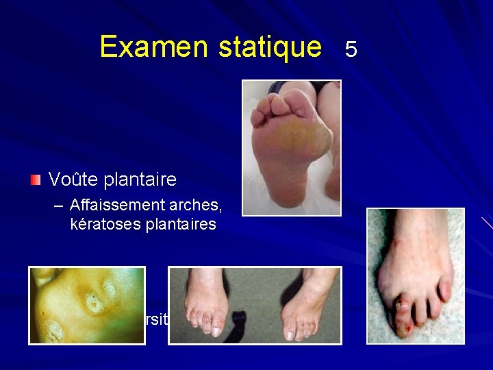 Examen statique Voûte plantaire – Affaissement arches, kératoses plantaires – Cors et bursites 5