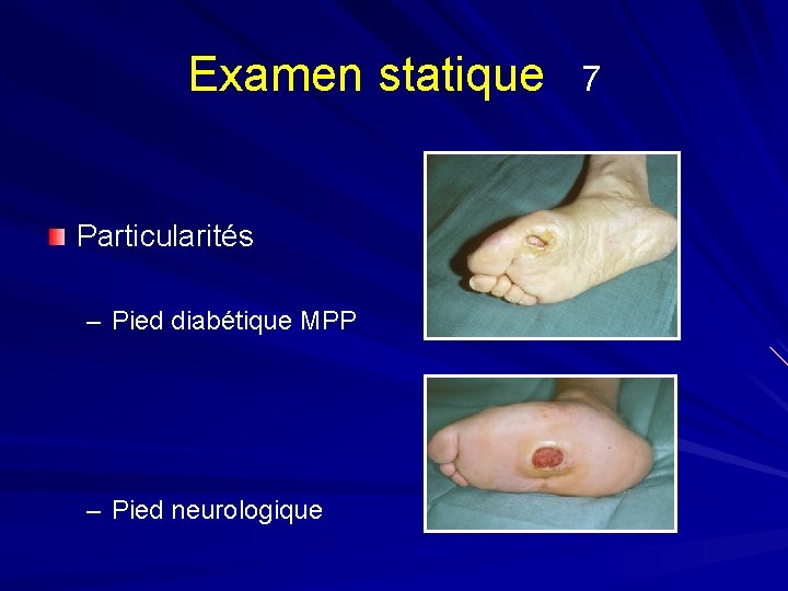 Examen statique Particularités – Pied diabétique MPP – Pied neurologique 7 