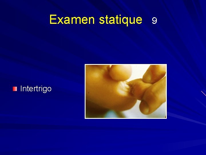 Examen statique Intertrigo 9 
