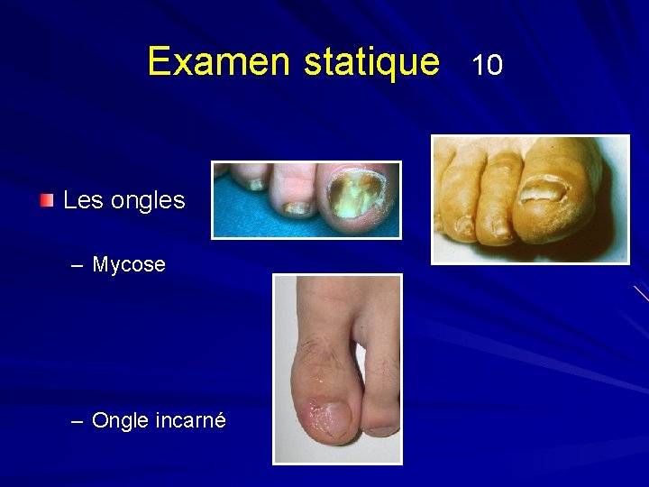 Examen statique Les ongles – Mycose – Ongle incarné 10 