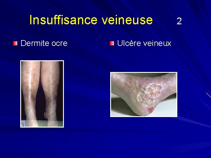 Insuffisance veineuse Dermite ocre Ulcère veineux 2 