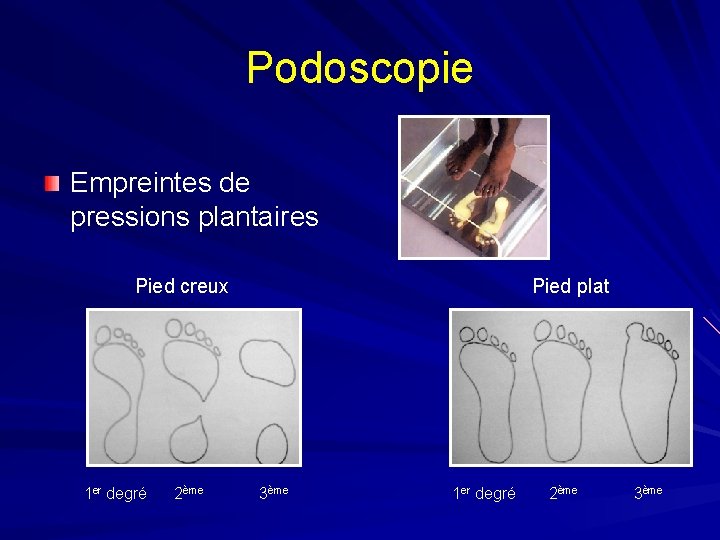 Podoscopie Empreintes de pressions plantaires Pied creux 1 er degré 2ème Pied plat 3ème