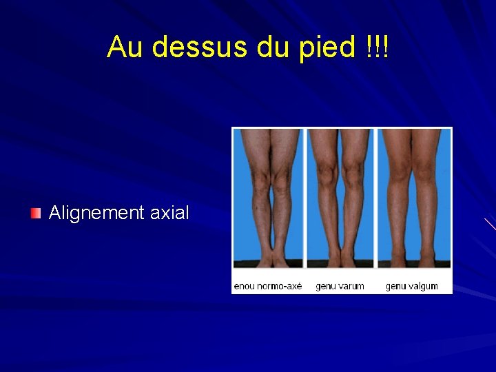 Au dessus du pied !!! Alignement axial 