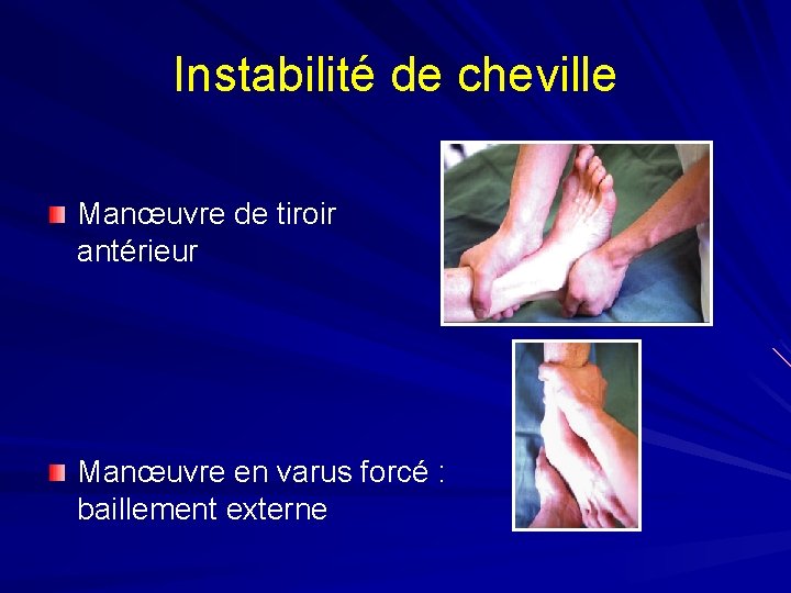 Instabilité de cheville Manœuvre de tiroir antérieur Manœuvre en varus forcé : baillement externe