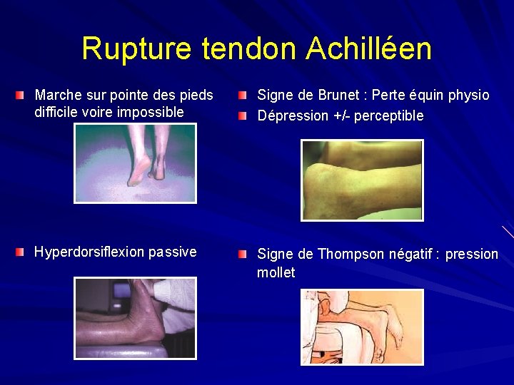 Rupture tendon Achilléen Marche sur pointe des pieds difficile voire impossible Signe de Brunet