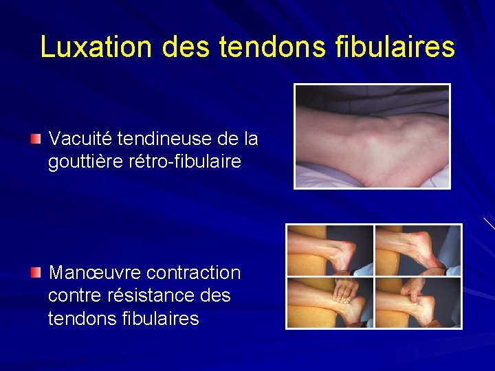 Luxation des tendons fibulaires Vacuité tendineuse de la gouttière rétro-fibulaire Manœuvre contraction contre résistance