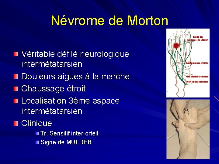 Névrome de Morton Véritable défilé neurologique intermétatarsien Douleurs aigues à la marche Chaussage étroit