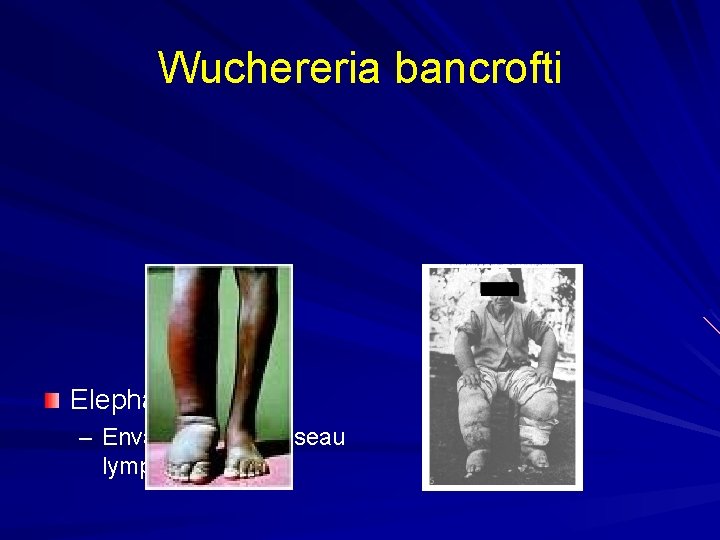 Wuchereria bancrofti Elephantiasis – Envahissement réseau lymphatique 