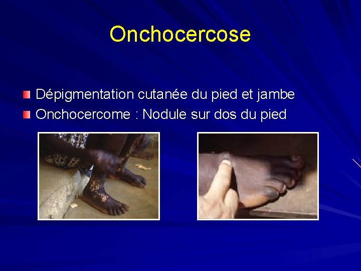 Onchocercose Dépigmentation cutanée du pied et jambe Onchocercome : Nodule sur dos du pied