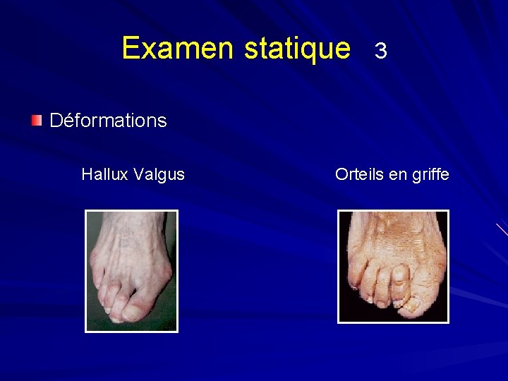 Examen statique 3 Déformations Hallux Valgus Orteils en griffe 