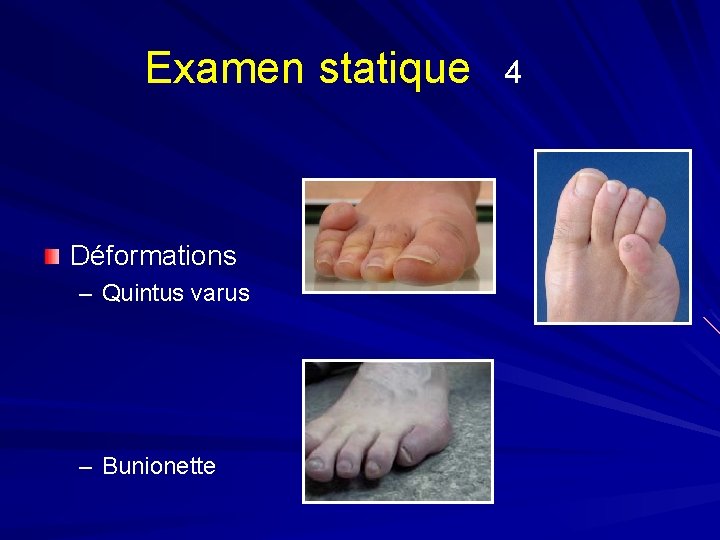 Examen statique Déformations – Quintus varus – Bunionette 4 