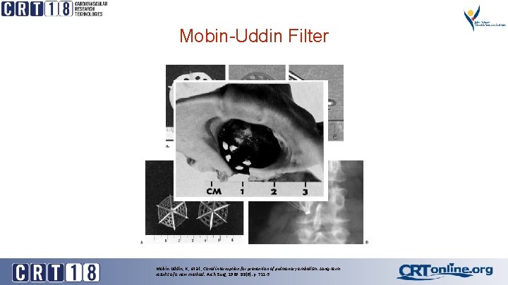 Mobin-Uddin Filter Mobin-Uddin, K. , et al. , Caval interruption for prevention of pulmonary