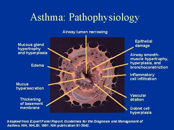 Asthma: Pathophysiology Airway lumen narrowing Mucous gland hypertrophy and hyperplasia Edema Epithelial damage Airway