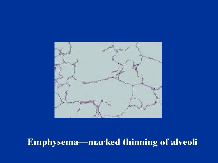 Emphysema—marked thinning of alveoli 