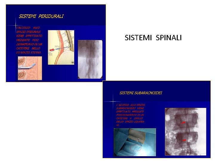 SISTEMI SPINALI 