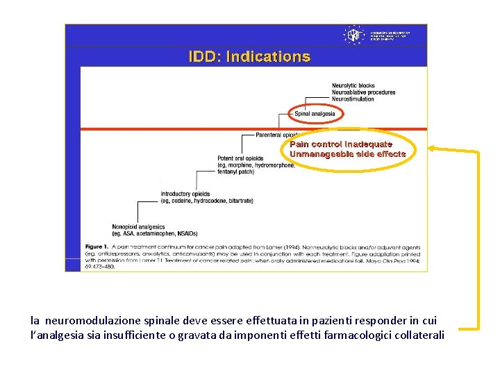 la neuromodulazione spinale deve essere effettuata in pazienti responder in cui l’analgesia insufficiente o