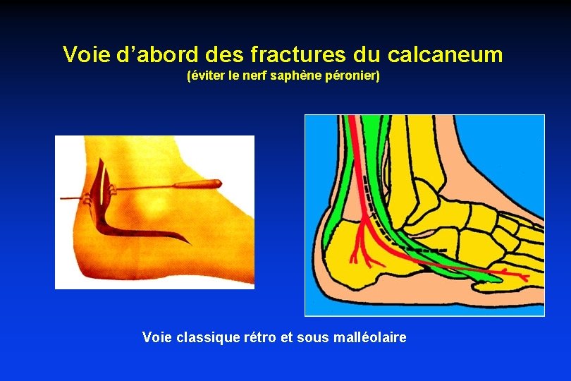 fractures-du-calcaneum-fractures-du-calcaneum-calcaneum-vue