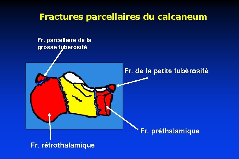 fractures-du-calcaneum-fractures-du-calcaneum-calcaneum-vue