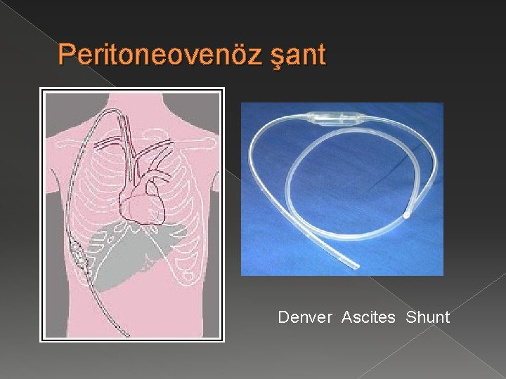 Peritoneovenöz şant Denver Ascites Shunt 