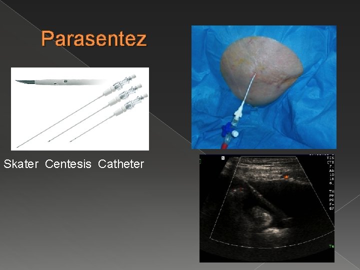 Parasentez Skater Centesis Catheter 