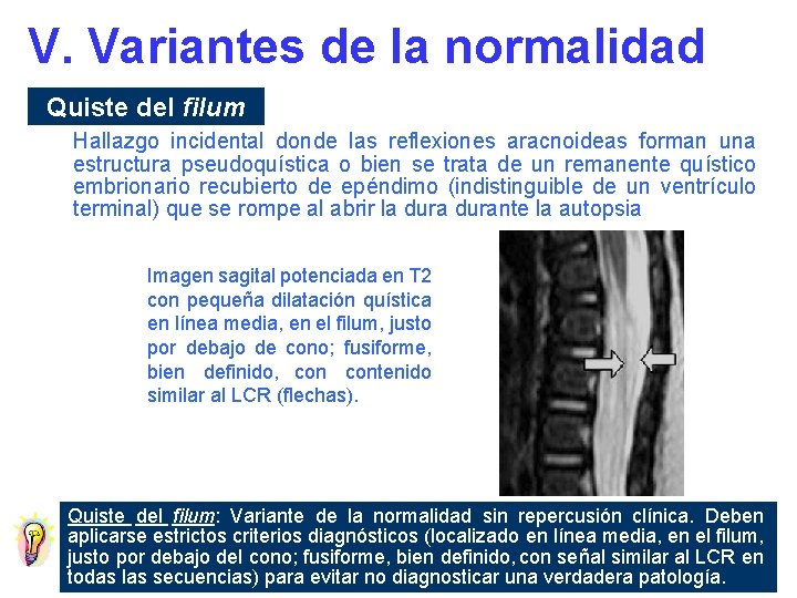 V. Variantes de la normalidad Quiste del filum Hallazgo incidental donde las reflexiones aracnoideas