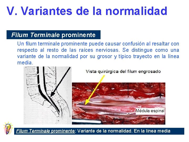 V. Variantes de la normalidad Filum Terminale prominente Un filum terminale prominente puede causar