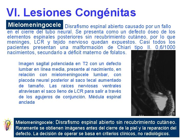 VI. Lesiones Congénitas Mielomeningocele Disrafismo espinal abierto causado por un fallo en el cierre