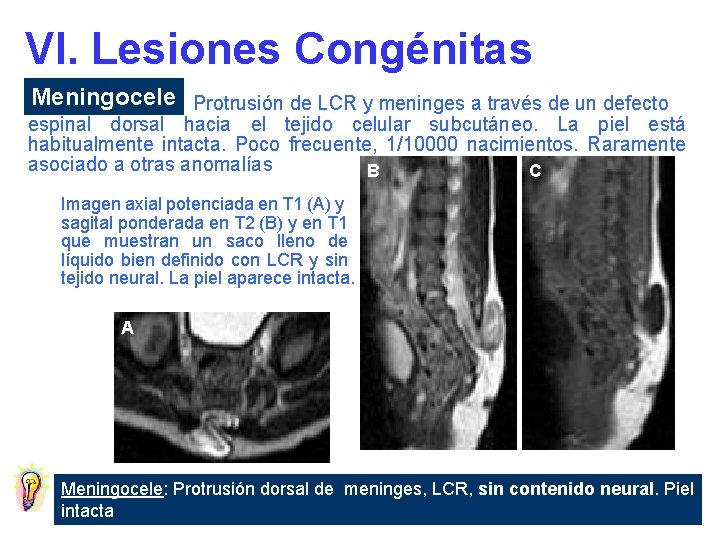 VI. Lesiones Congénitas Meningocele Protrusión de LCR y meninges a través de un defecto