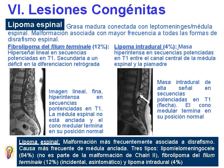 VI. Lesiones Congénitas Lipoma espinal Grasa madura conectada con leptomeninges/médula espinal. Malformación asociada con