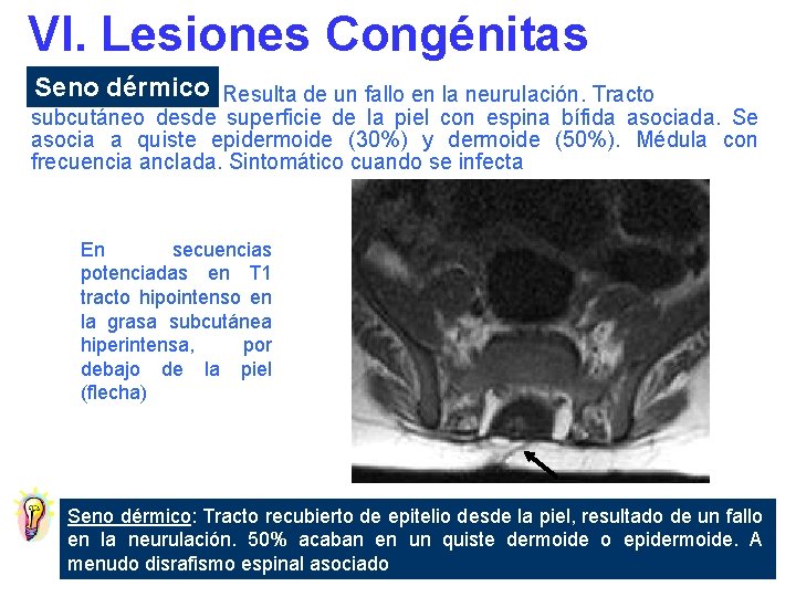 VI. Lesiones Congénitas Seno dérmico Resulta de un fallo en la neurulación. Tracto subcutáneo