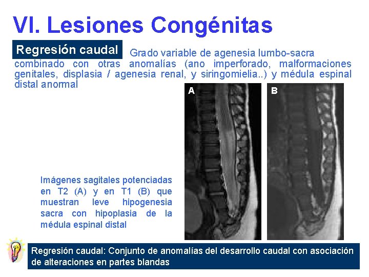 VI. Lesiones Congénitas Regresión caudal Grado variable de agenesia lumbo-sacra combinado con otras anomalías