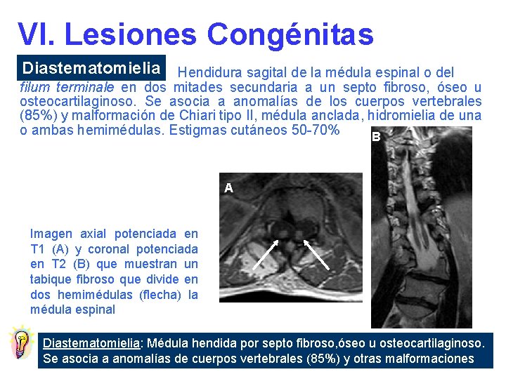 VI. Lesiones Congénitas Diastematomielia Hendidura sagital de la médula espinal o del filum terminale