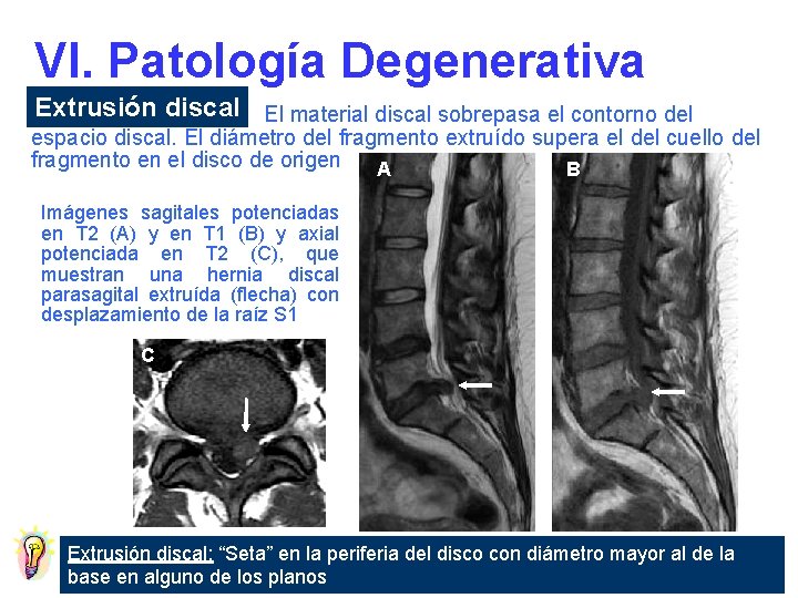 VI. Patología Degenerativa Extrusión discal El material discal sobrepasa el contorno del espacio discal.