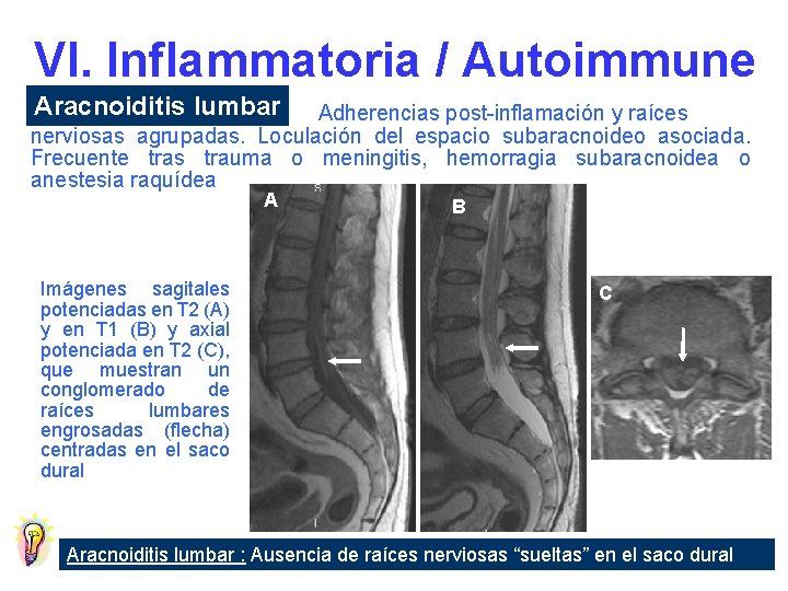 VI. Inflammatoria / Autoimmune Aracnoiditis lumbar Adherencias post-inflamación y raíces nerviosas agrupadas. Loculación del