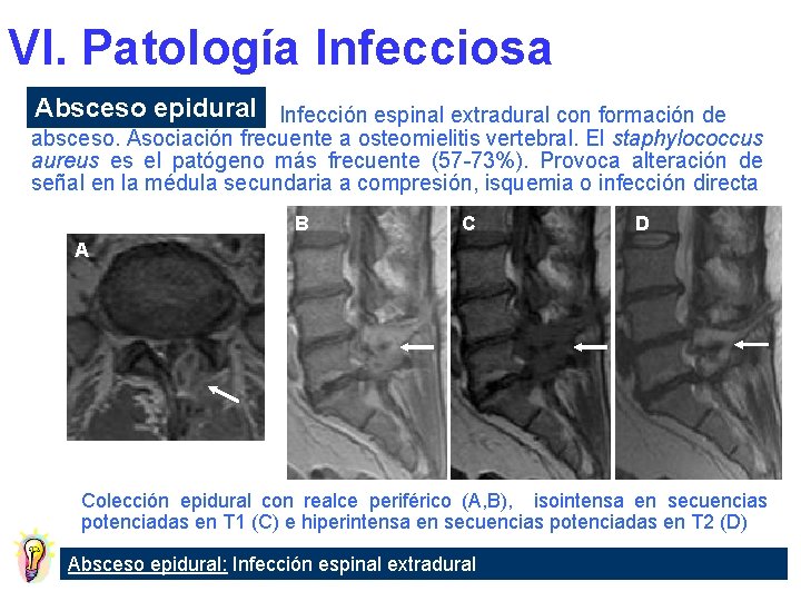 VI. Patología Infecciosa Absceso epidural Infección espinal extradural con formación de absceso. Asociación frecuente