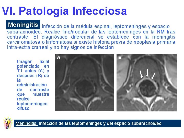 VI. Patología Infecciosa Meningitis Infección de la médula espinal, leptomeninges y espacio subaracnoideo. Realce
