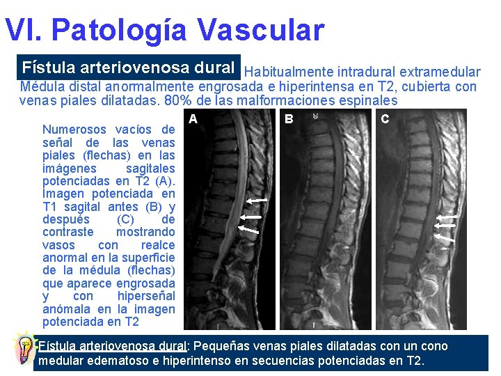 VI. Patología Vascular Fístula arteriovenosa dural Habitualmente intradural extramedular Médula distal anormalmente engrosada e