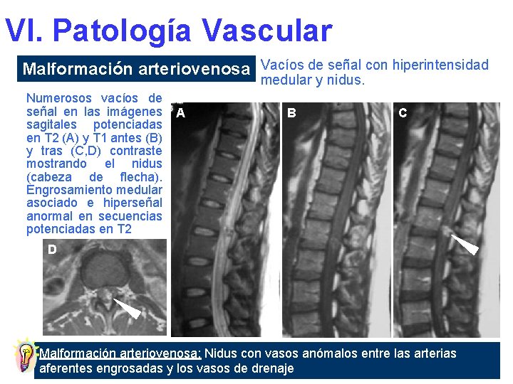 VI. Patología Vascular Malformación arteriovenosa Vacíos de señal con hiperintensidad medular y nidus. Numerosos