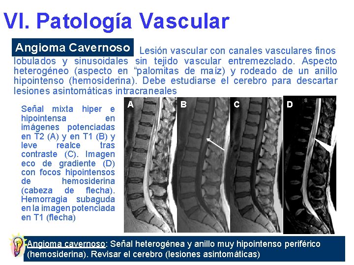 VI. Patología Vascular Angioma Cavernoso Lesión vascular con canales vasculares finos lobulados y sinusoidales