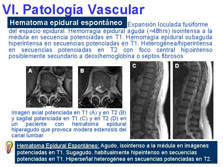 VI. Patología Vascular Hematoma epidural espontáneo Expansión loculada fusiforme del espacio epidural. Hemorragía epidural