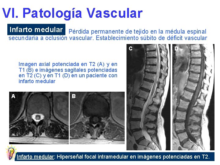 VI. Patología Vascular Infarto medular Pérdida permanente de tejido en la médula espinal secundaria