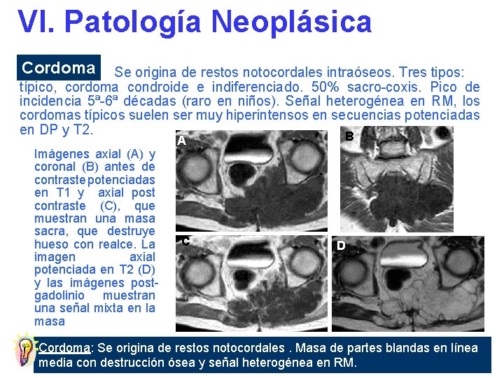 VI. Patología Neoplásica Cordoma Se origina de restos notocordales intraóseos. Tres tipos: típico, cordoma