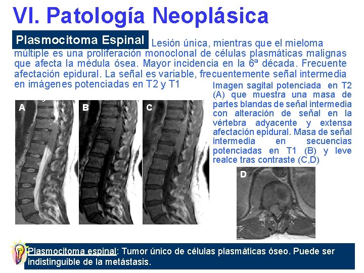 VI. Patología Neoplásica Plasmocitoma Espinal Lesión única, mientras que el mieloma múltiple es una
