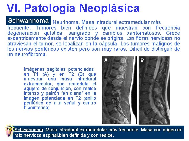 VI. Patología Neoplásica Schwannoma Neurinoma. Masa intradural extramedular más frecuente. Tumores bien definidos que