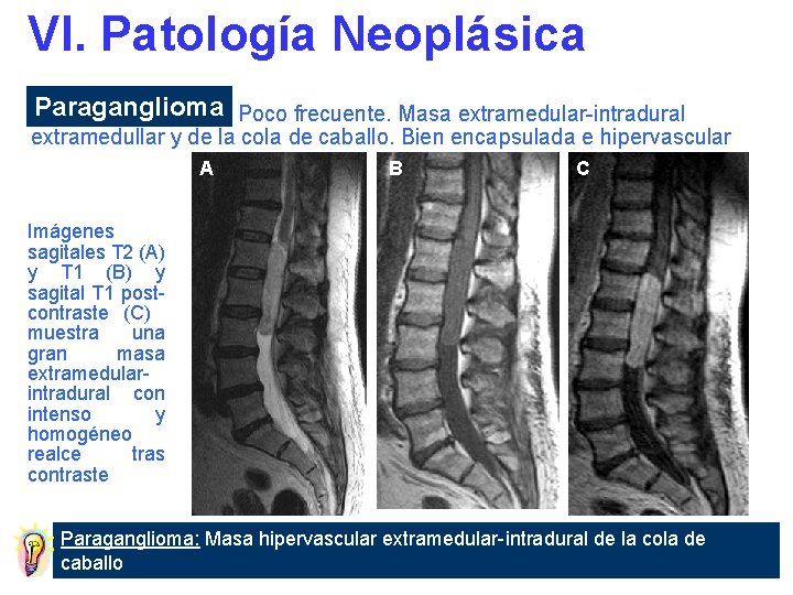 VI. Patología Neoplásica Paraganglioma Poco frecuente. Masa extramedular-intradural extramedullar y de la cola de