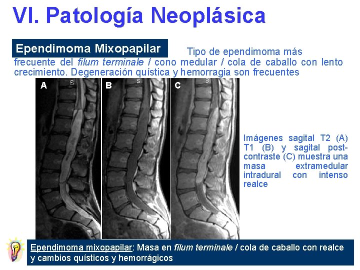 VI. Patología Neoplásica Ependimoma Mixopapilar Tipo de ependimoma más frecuente del filum terminale /