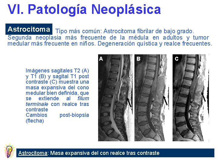 VI. Patología Neoplásica Astrocitoma Tipo más común: Astrocitoma fibrilar de bajo grado. Segunda neoplasia